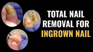 Total Nail Removal For Ingrown Toenail [upl. by Booma]