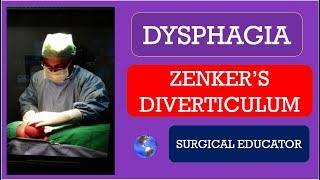 ZENKERS DIVERTICULUM  How To DIAGNOSE amp TREAT DYSPHAGIA [upl. by Nayhr267]