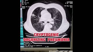 Cryptogenic organizing pneumonia pneumonia radiology shortvideo [upl. by Valenza]