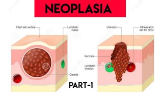 Neoplasia  Pathology  Types  Classification  Characteristics  Harsh Mohan  part1 [upl. by Gebler687]