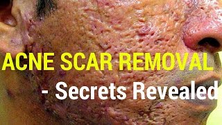 How to treat acne scars Dermatology Secrets revealed [upl. by Rikahs9]