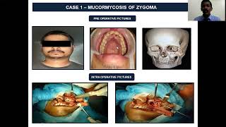 SRM Dental College Ramapuram  Mucormycosis [upl. by Ahen]