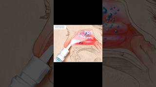 Nasonex Treatment Of Sneezing or Runny nose [upl. by Suoiluj]