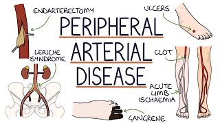 Understanding Peripheral Arterial Disease [upl. by Gaylord]