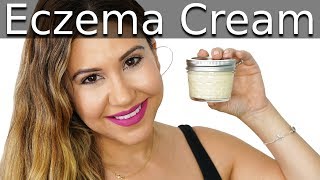 DIY Eczema Cream  Itchy Skin Relief [upl. by Tenenbaum]