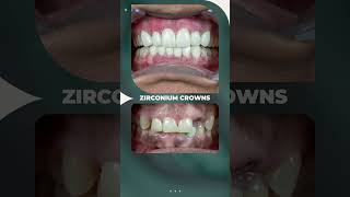 Zirconium Crowns Transform Your Smile amp Boost Your Confidence 🌟 [upl. by Noivert]