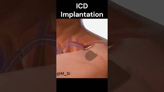 ICD implementation [upl. by Douville]