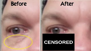 How Use Trichloroacetic Acid on Xanthelasma Spots Around Eyes at Home WARNING My BAD Experience TCA [upl. by Amadis313]