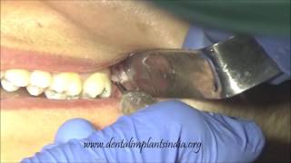 Wisdom tooth removal in 5 MIN or less Surgical Guide Online Course  Free eBook [upl. by Shererd]