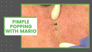 Pimple Popping with Mario  Dr Derm [upl. by Enialahs600]