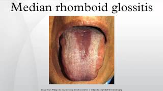 Median rhomboid glossitis [upl. by Lahcym]