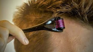 Derma roller for hair regrowth  Hair care video howto vlog [upl. by Evelyn211]