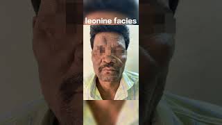 leprosy leonine facies dermatology leprosy bacterialdiseases kusti facies [upl. by Christianity140]