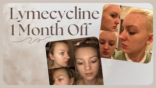 1 MONTH OFF LYMECYCLINE [upl. by Buzzell963]