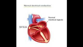 Sick sinus syndrome [upl. by Aramoiz]