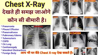 How to read a chest Xray  Pneumonia  Lungs effusion  TB  CA lungs  Pneumothorax  COPD xray [upl. by Auqeenwahs]