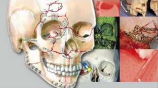 Craniomaxillofacial Buttresses Anatomy and Operative Repair [upl. by Iren]