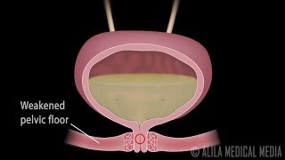 Stress Urinary Incontinence in Women Animation [upl. by Nork]