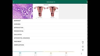 Adenomyosis  الانتباذ العضلي الغدي [upl. by Yeleen]