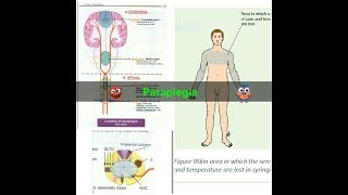 Paraplegia [upl. by Lorens]