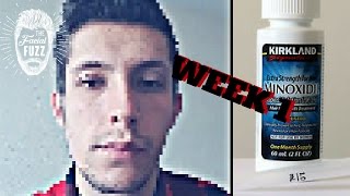 Minoxidil Beard  Week 1  Minoxidil 5 for Beard Growth  Facialfuzzfridays [upl. by Elletsyrk]