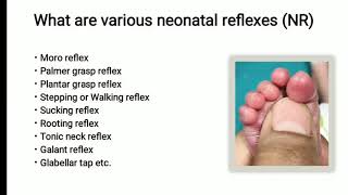 Neonatal Reflex  Plantar Grasp Reflex  Pediatrics [upl. by Acirtal]