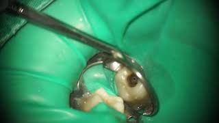 Root canal treatment Patency and Gilde Path [upl. by Ydnyc]