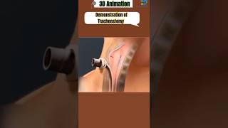 Tracheotomy procedure 3D Animationviralshort [upl. by Enidaj11]