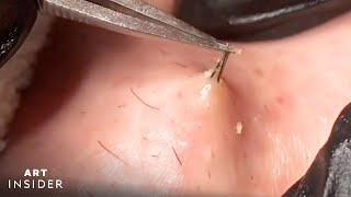 How Ingrown Hairs Are Removed  Art Insider [upl. by Haydon396]