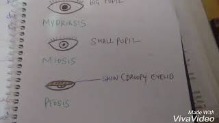 Mydriasis miosis and ptosis [upl. by Giannini37]