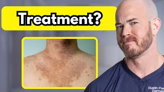 How to Treat Tinea Versicolor  Dr Dustin Portela [upl. by Rawde]