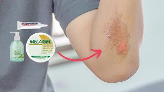 Healing Abrasions Effectively with Melaleuca Products [upl. by Viscardi]