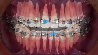 Clinical tip Midline Correction with Intermaxillary Elastics｜【Chris Chang Ortho】CC451 [upl. by Stormie]