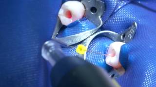 Root canal disinfection with SIROLaser Blue [upl. by Oel]