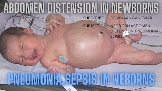 Abdominal Distension In Neonates  Pneumonia In Neonates  Sepsis In Newborn  Neonates In NICU [upl. by Lind]