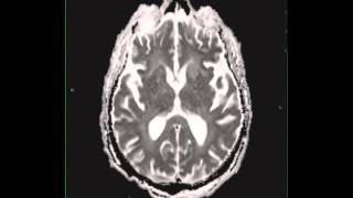 Cryptococcal meningitis [upl. by Bysshe136]