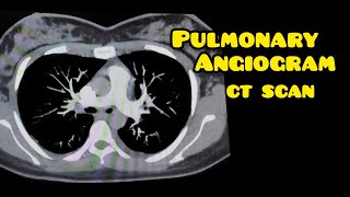 Pulmonary Angiogram CT Scan  Radiology  Cardiology [upl. by Navada344]