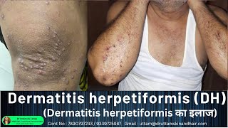 Dermatitis herpetiformis DH का इलाज  Itching water filled rashes on elbow knee Dr Uttam Lenka [upl. by Thalia104]