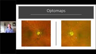 Using the RETeval ERG for Glaucoma w Dr Mike Cymbor OD [upl. by Airt]