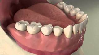 Implants Overdenture Lower Procedure [upl. by Arhas]