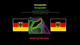 Sonographie  Cholezystitis [upl. by Eiramlehcar804]