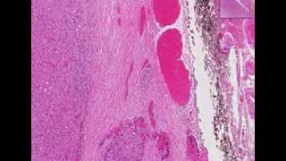 Histopathology ThyroidFollicular carcinoma [upl. by Trumann]