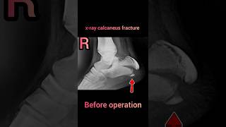 xray calcaneus fracture vairalvideo anatomy vairalvideo radiological [upl. by Itak]