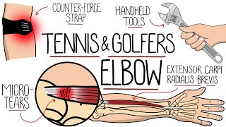 Understanding Tennis Elbow and Golfers Elbow Lateral amp Medial Epicondylitis [upl. by Llednek]