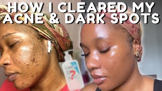 HOW I CLEARED MY ACNE BREAKOUTS AND DARK SPOTS NO TRETINOIN  iJay Amadi [upl. by Nageet]