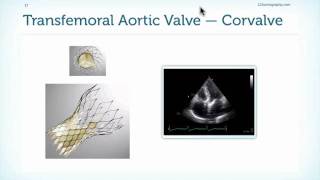 Assessment of Prostheses in Echocardiography [upl. by Serene290]