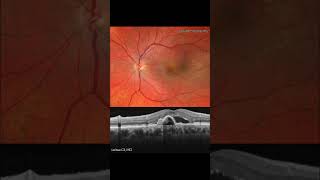 POLYPOIDAL CHOROIDAL VASCULOPATHY MULTIMODAL ANALYSIS For more images like this visit wwwretinograp [upl. by Nirtiak149]