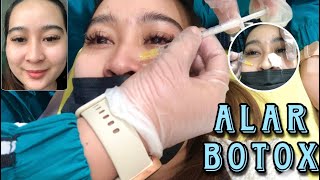 PROCEDURE FOR ALAR BOTOX SEE THE RESULT [upl. by Chlori]