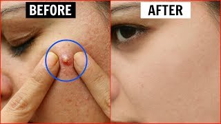 एक ही रात में Pimples हो जाएंगे गायब  Remove Pimples Overnight  Anaysa [upl. by Llebiram]