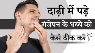 दाढ़ी में पड़े गंजेपन के धब्बे को कैसे ठीक करे  Alopecia Areata Beard  Alopecia Areata Treatment [upl. by Hogan]